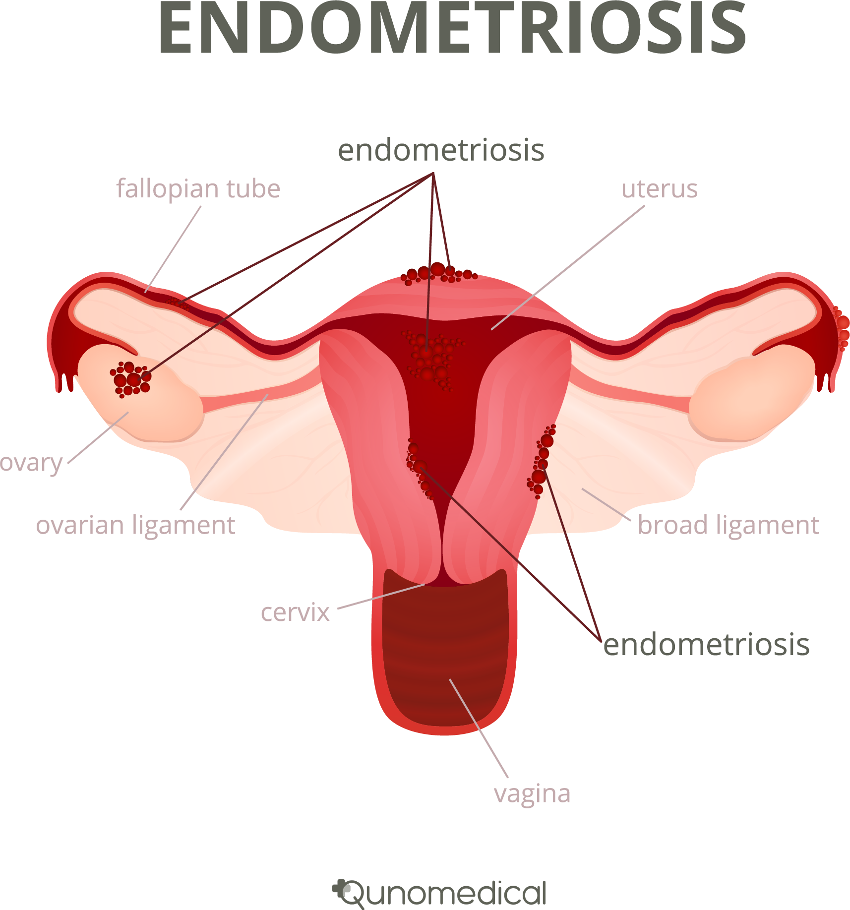 Endometriosis Hysterectomy Is No Go To Cure Qunomedical