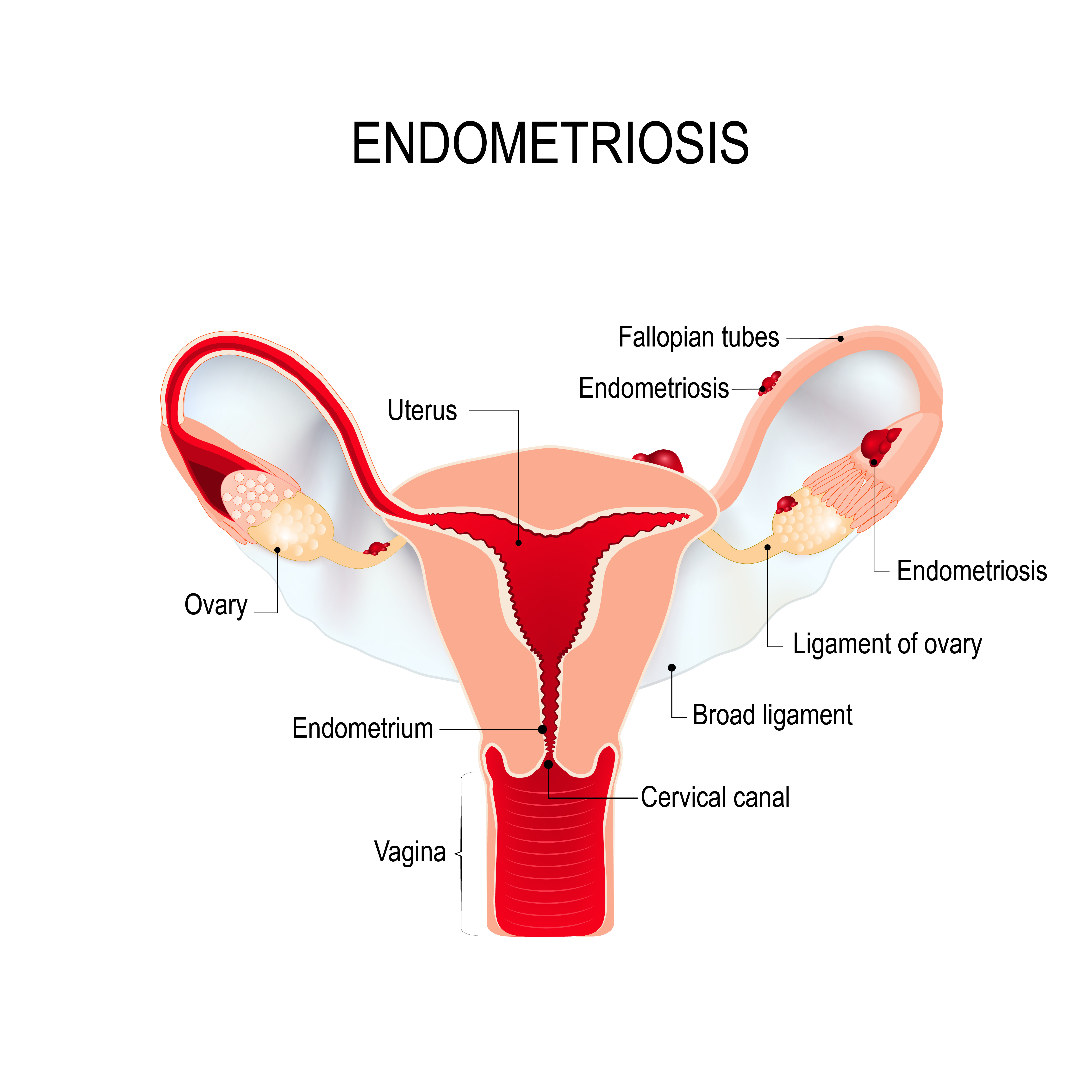 What are some basic facts about endometriosis?