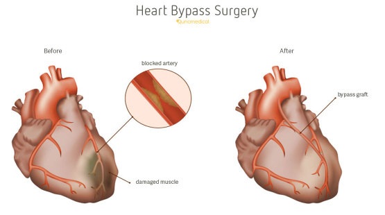 Heart Bypass Surgery Qunomedical