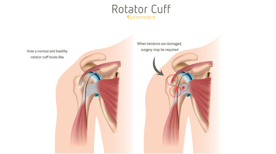 Arthroscopic Rotator Cuff Repair Qunomedical