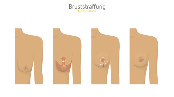 Bruststraffung nach Gewichtsverlust Kosten Bruststraffung nach Gewichtsverlust Kosten