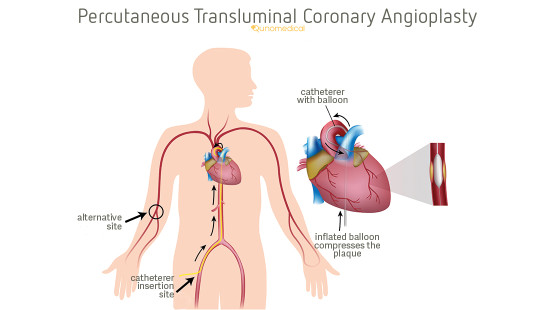 Percutaneous Transluminal Coronary Angioplasty Qunomedical