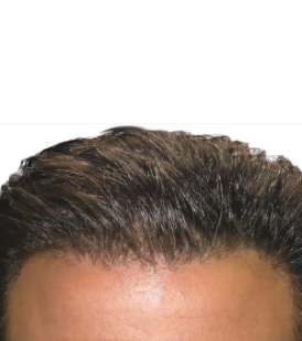 Fue Haartransplantation In Der My Perfect Hair Transplant Berlin Qunomedical