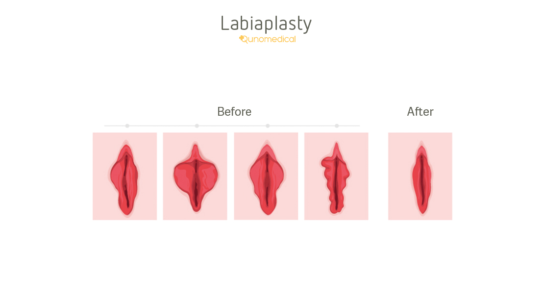 Exposing your clitoris