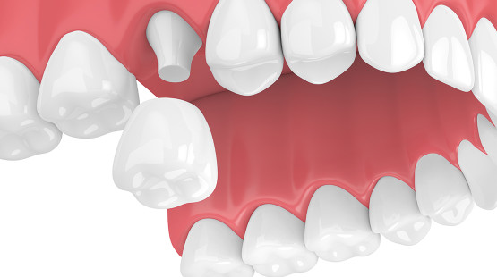 what are zirconia crowns qunomedical zirconia crowns