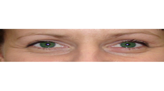 Upper And Lower Blepharoplasty Clinics Reviews Qunomedical