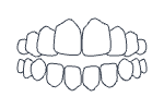 Open Bite