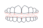 Teeth Grinding
