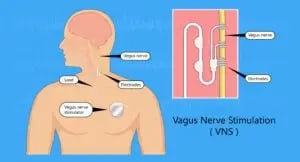 An image of a Vagus Nerve Stimulation device used for vagal toning for anxiety therapy