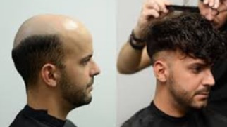 Prótesis capilares en Toque Perfecto