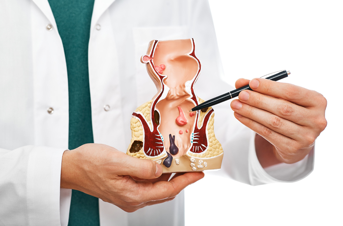 Surgeon holding an anatomical model of the anal canal and pointing to a haemorrhoid