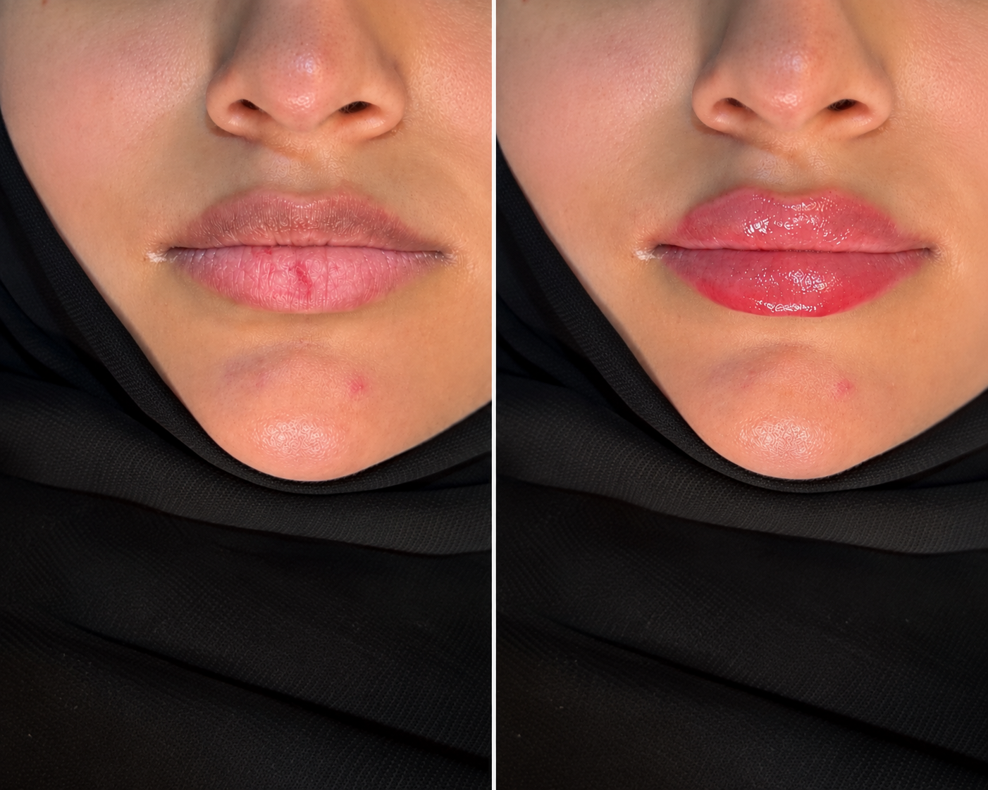لمسة فيلر.. لجمال طبيعي ومتوازن 💋✨