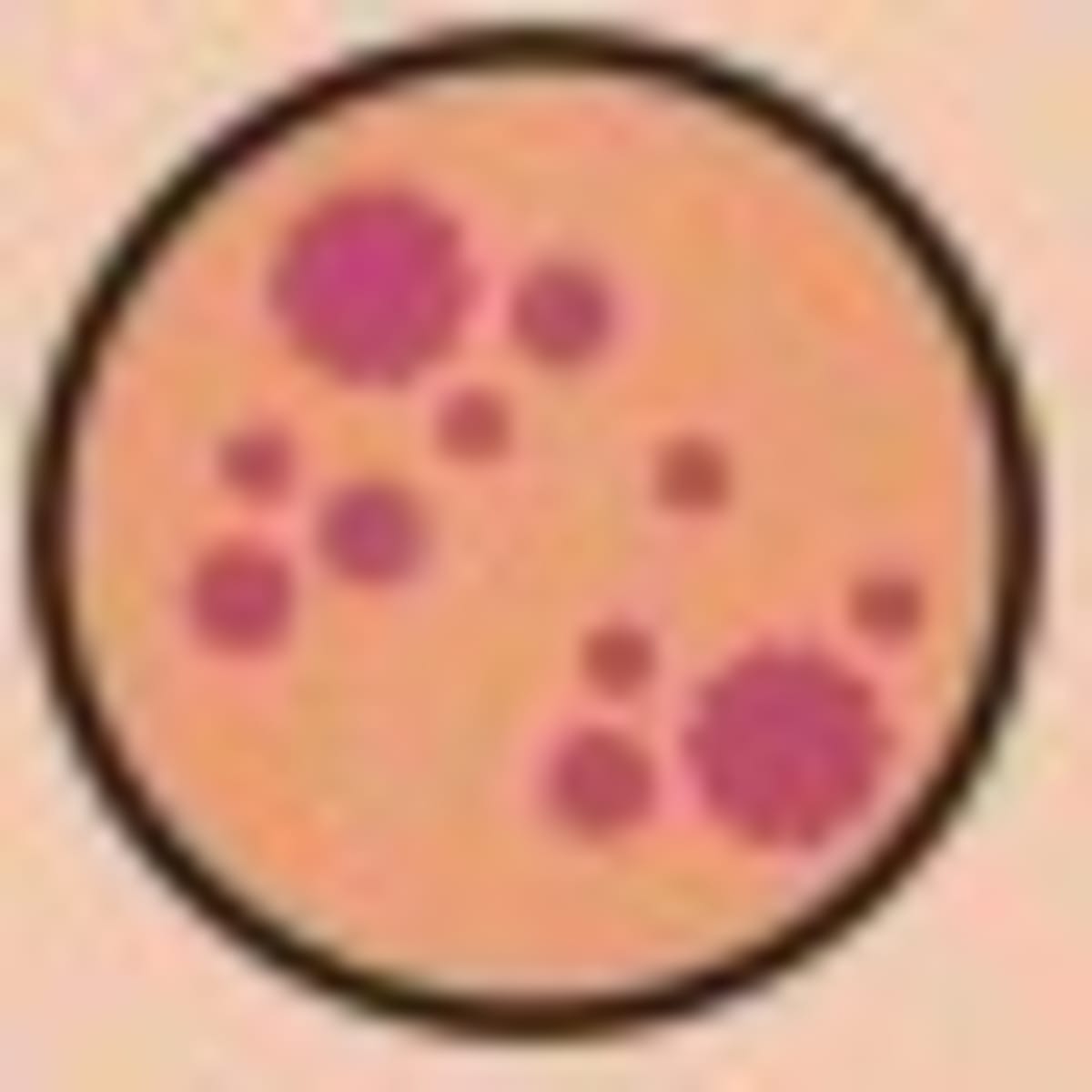 Pennsylvania Reports Sixth Death Associated With Measles