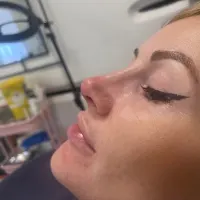 Rhinoplasty (non Surgical Nose Job)