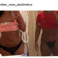 Fat Dissolving - 1 Large Area