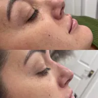 Rhinoplasty (non Surgical Nose Job)