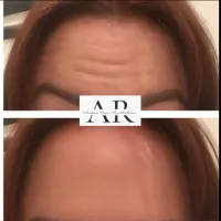 Botox - 3 Areas