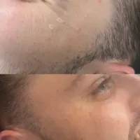 Botox - 2 Areas