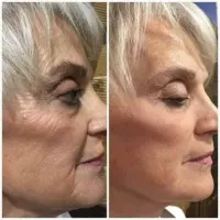 Botox In A Sachet