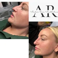 Rhinoplasty (non Surgical Nose Job)