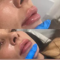 Lips - 0.7ml
