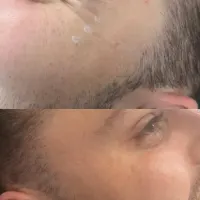 Botox - 1 Area