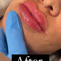 Lips - 0.7ml