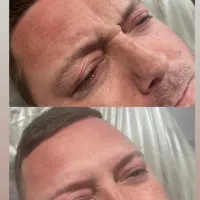 Botox - 1 Area
