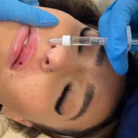 Lips - 0.7ml