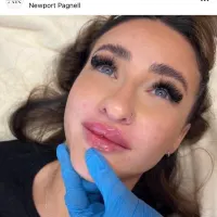 Lips - 0.7ml
