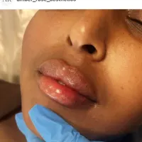 Lips - 0.7ml