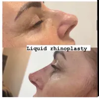 Rhinoplasty (non Surgical Nose Job)