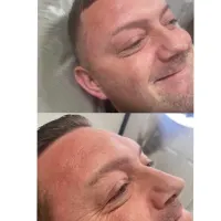 Botox - 1 Area