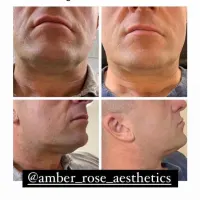 Fat Dissolving - 1 Large Area