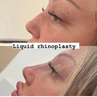 Rhinoplasty (non Surgical Nose Job)