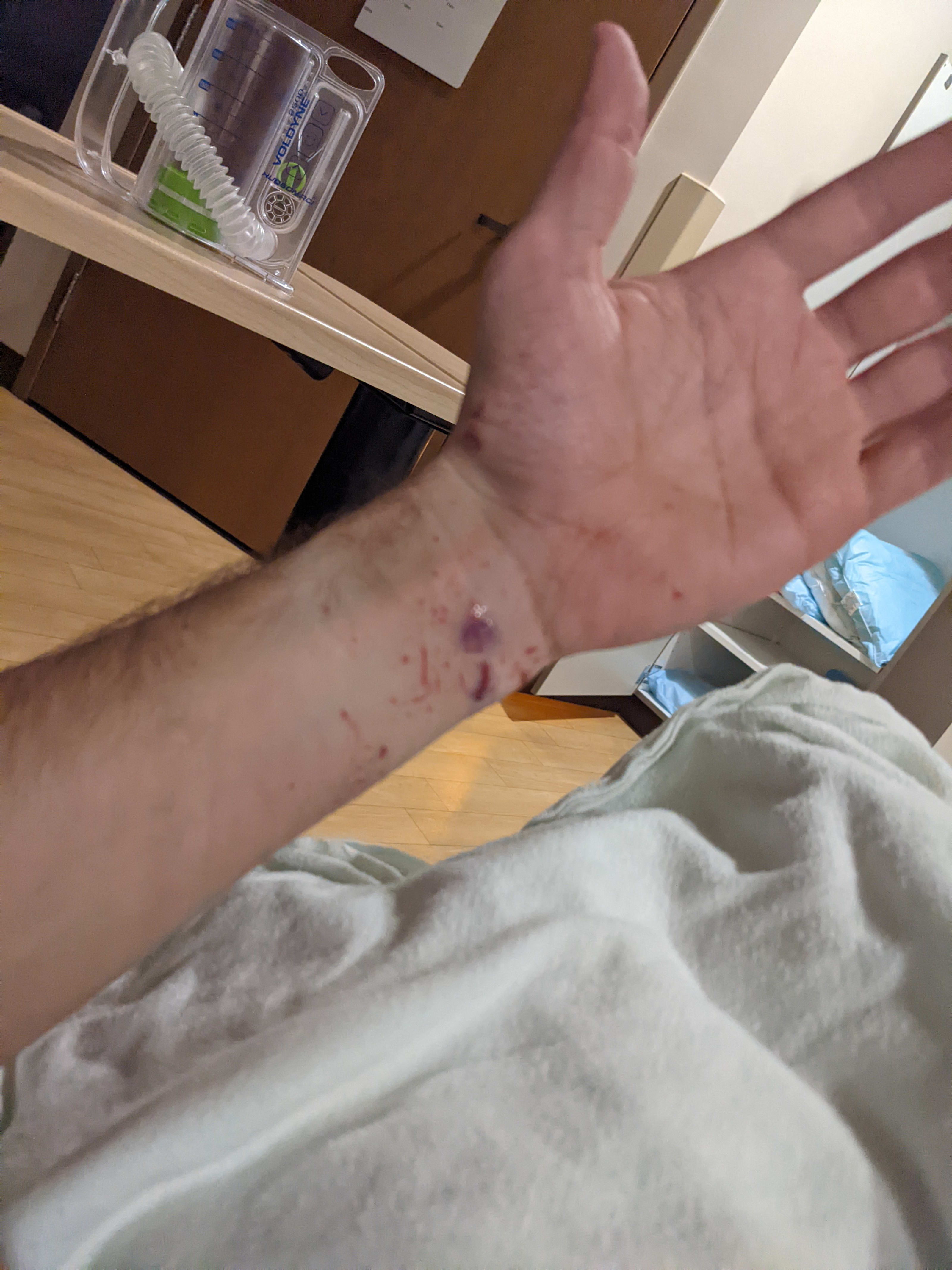 Kent's left wrist with cuts and glue covering a cut