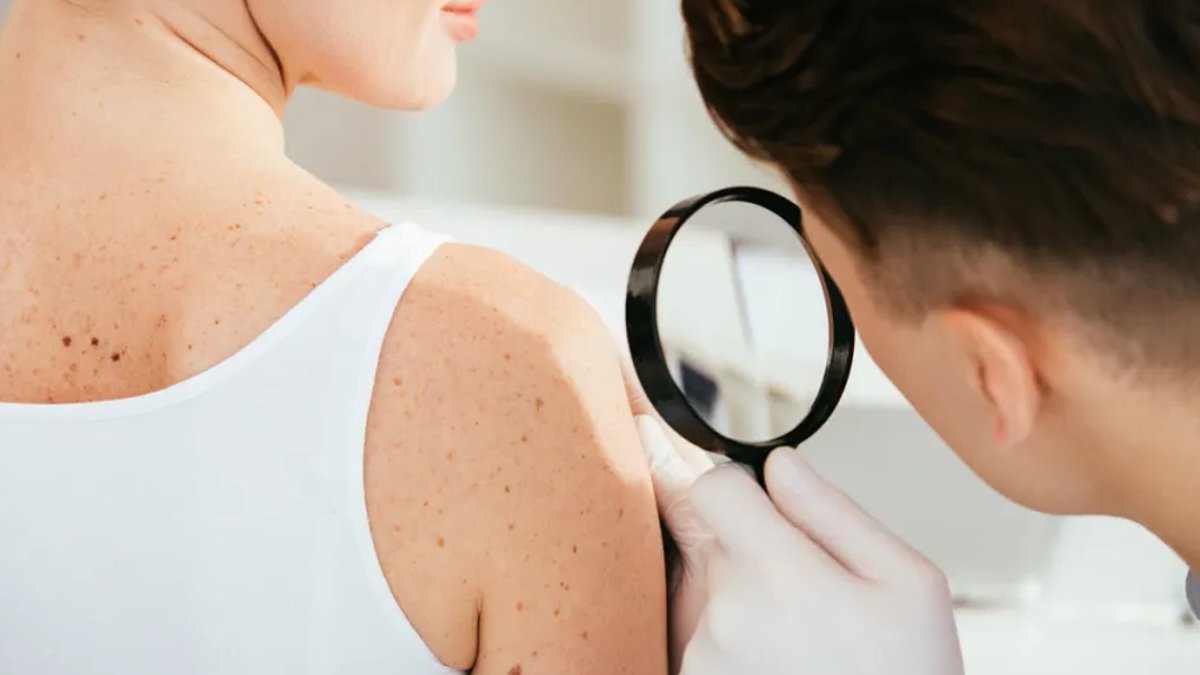 Melanoma cases to reach 263000 by 2035 Melanoma cases to reach 263000 by 2035 - melanoma cases
