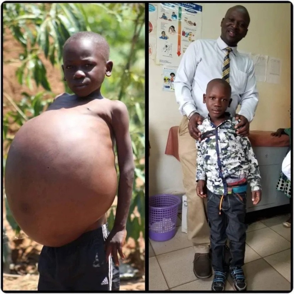 Allan before the surgery that saved his life and after the surgery with surgeon Dr Nasser Kakembo