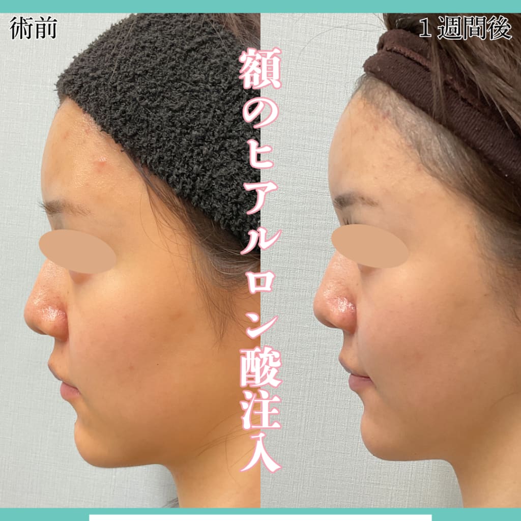 ヒアルロン酸注射（ボラックス）1cc（額や鼻筋など3部位から選択