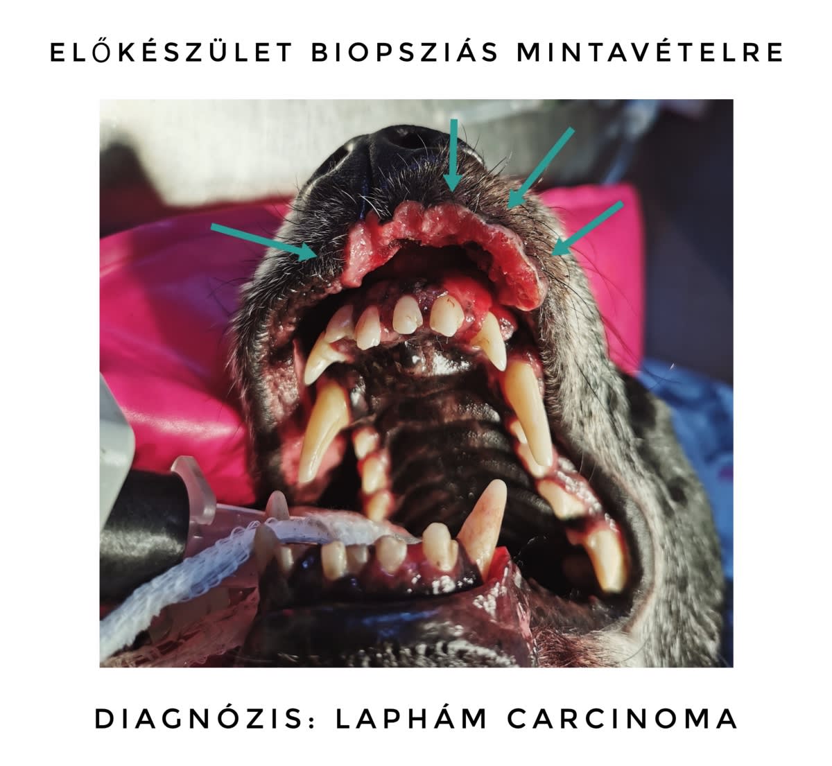 laphám carcinoma