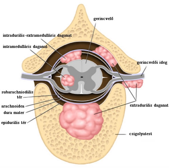 Gerincvelő tumor