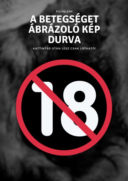 Fekélyes perianal adenoma (felkavaró kép)