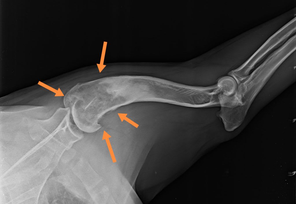 Miért alakul ki osteosarcoma?