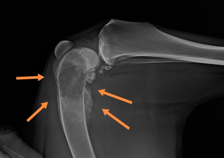 osteosarcoma – mi jellemző erre a betegségre?