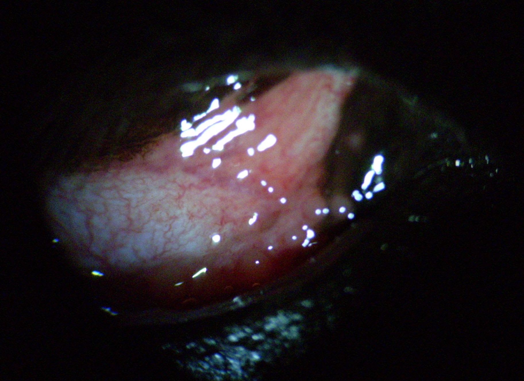 tüszős kötőhártyagyulladás - Follicularis conjunctivitis