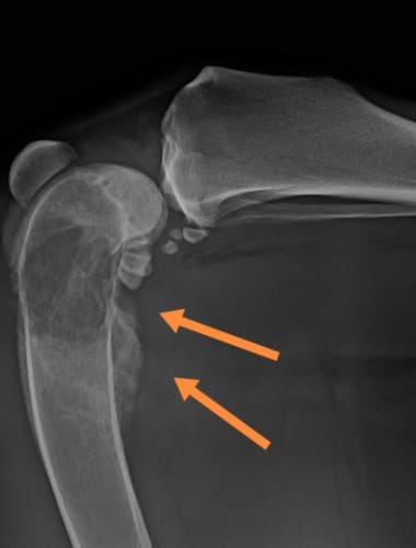 Osteosarcoma