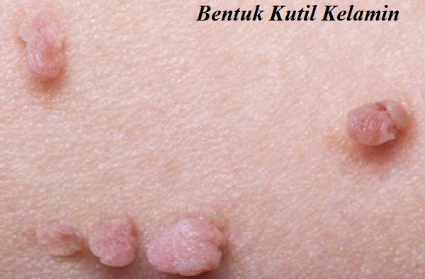 Gambar Kutil Kelamin Gambar Kutil Kelamin