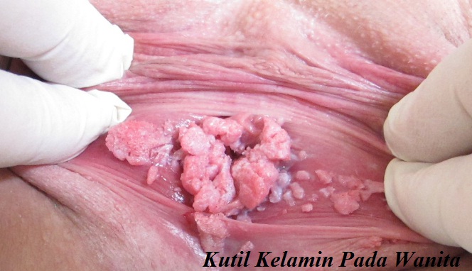 Kutil Kelamin Pada Wanita Kutil Kelamin Pada Wanita