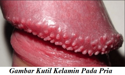 Kutil Kelamin Pada Pria Kutil Kelamin Pada Pria