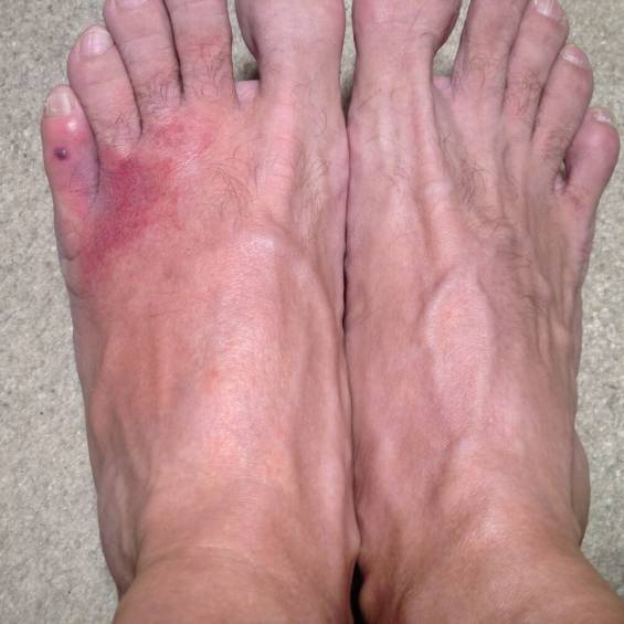 Inflammation, and redness in the left foot, compared to the right